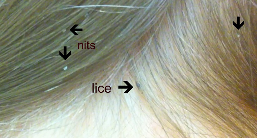 How to get rid of lice 